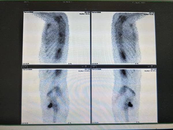骨掃描-5.jpg