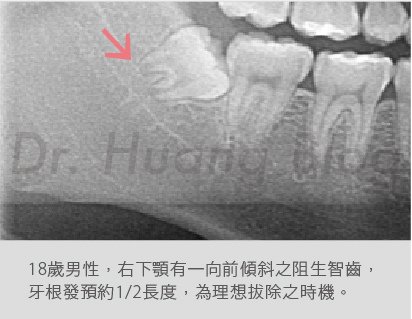 口內智齒X光片-06.jpg