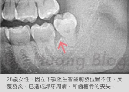 口內智齒X光片-05.jpg