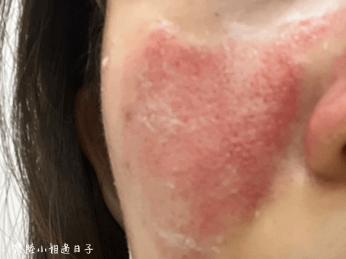 韓國LDM細胞再生活膚儀_綵瀅spa美容館