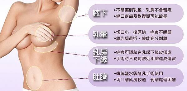 內視鏡隆乳植入位置表格