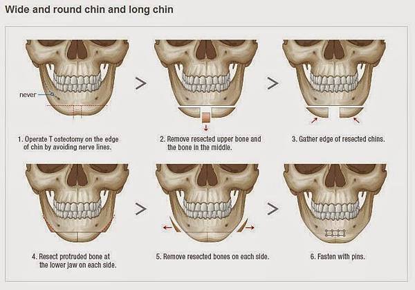 下巴截骨V-Line手術.JPG