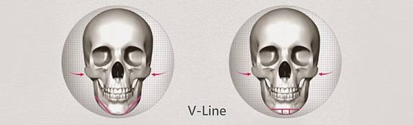 比墊下巴手術更自然的下巴截骨V-Line手術.jpg