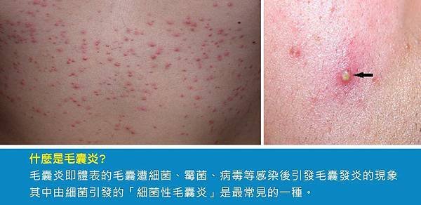 毛囊炎01.jpg