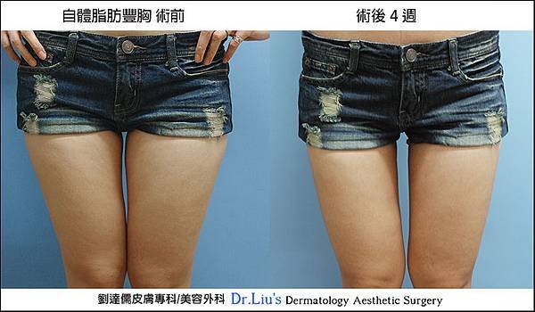 小馬3d 動力抽脂