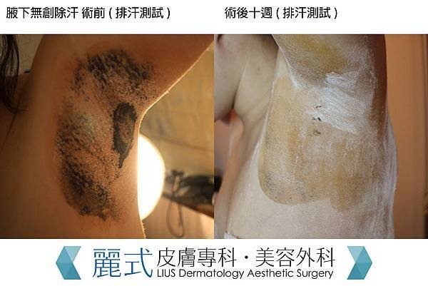 hyperhidrosis (3).jpg