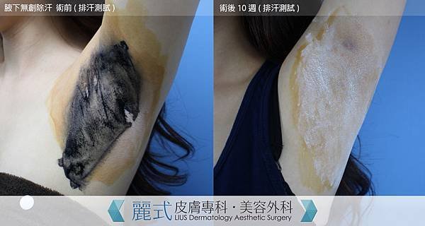 hyperhidrosis (7).jpg