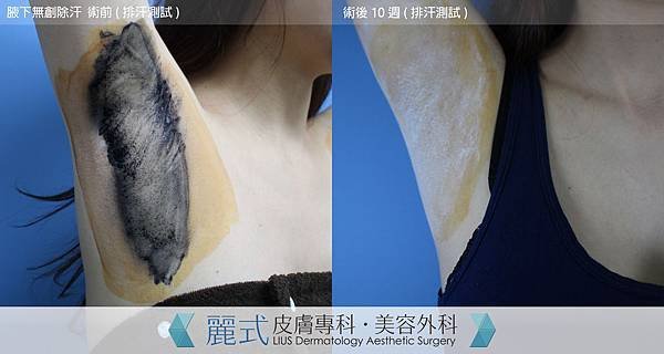 hyperhidrosis (9).jpg