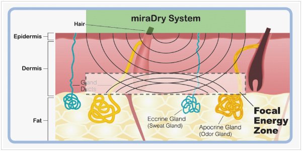 miraDry_05.jpg