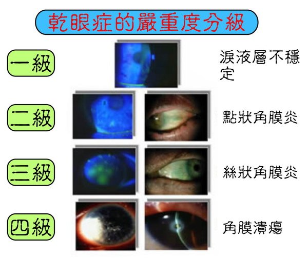 02  乾眼症03.jpg