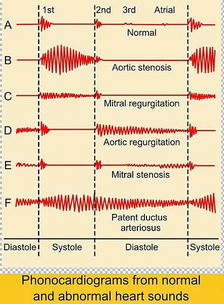 Phonocardiograms_from_normal_and_abnormal_heart_sounds.jpg