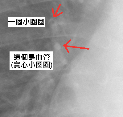 peribronchial cuffing.png