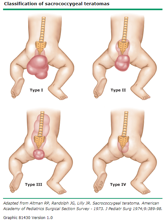 classification_of_sacrococcygeal_teratomas.PNG