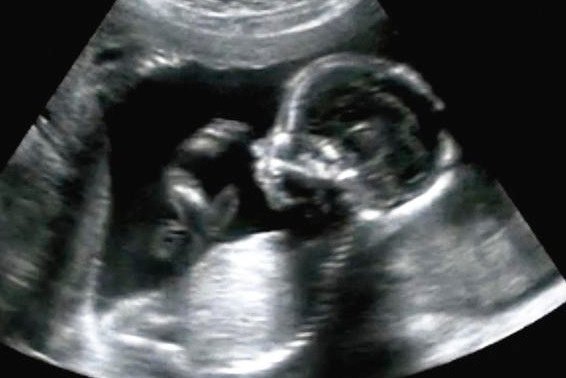 ultrasound_fetus.jpg