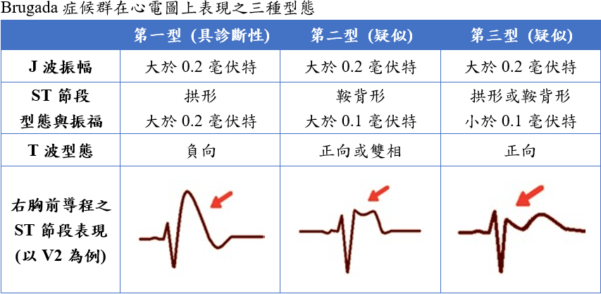 three_types_of_brugada_syndrome.PNG