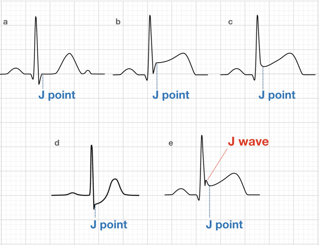 ECG_J_wave_Osborn_wave.png