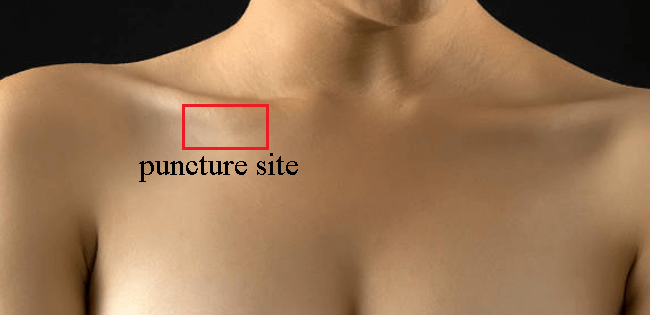 subclavian.PNG