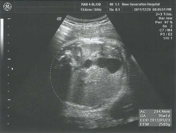 34w+6d