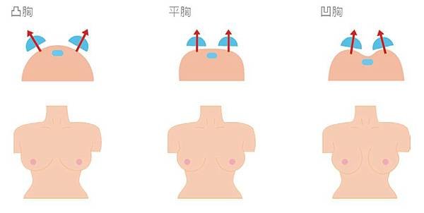 breast shape2.jpg