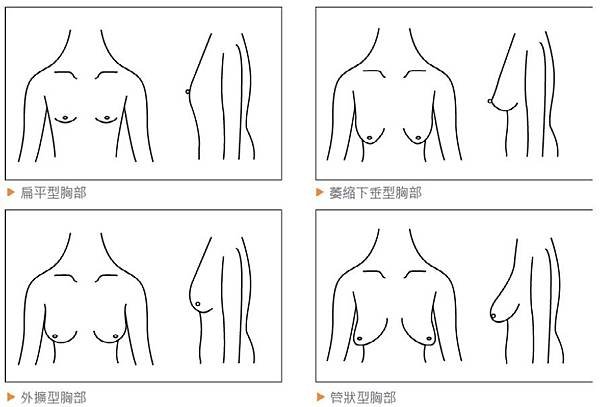 breast shape.jpg