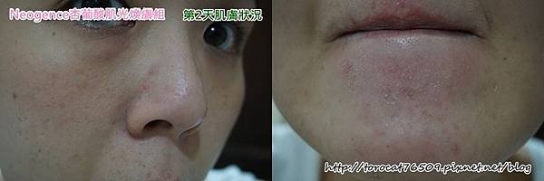 Neogence杏葡酸肌光膚組- 第2天肌膚狀況1.jpg