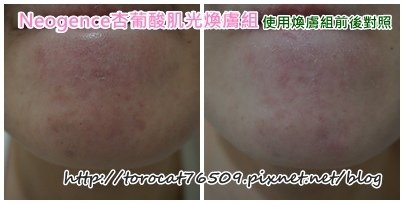 Neogence杏葡酸肌光膚組-使用七天前後照4.jpg