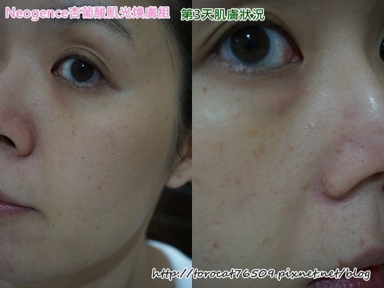 Neogence杏葡酸肌光膚組-第3天肌膚狀況.jpg