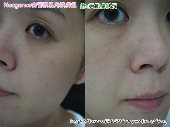 Neogence杏葡酸肌光膚組-第4天肌膚狀況.jpg