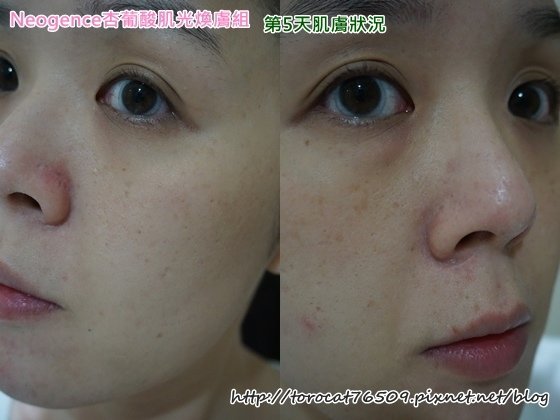 Neogence杏葡酸肌光膚組-第5天肌膚狀況.jpg