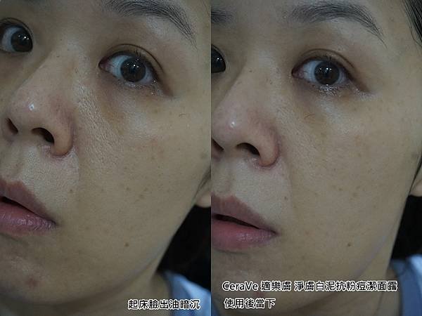 CeraVe 適樂膚 淨膚白泥抗粉痘潔面露-6（使用前後.jpg