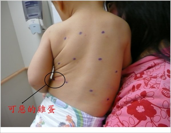 20081121_skin test 02.JPG