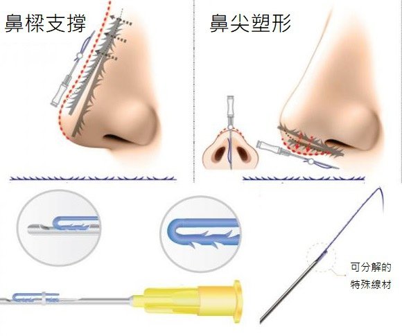 skin_care_magik_thread_pdo_thread_polidioxanone_pdo_4d_cog_18g_150mm_thread_r.jpg