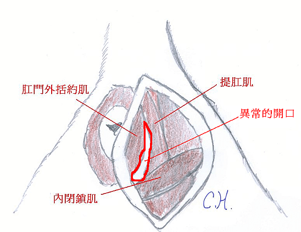 prianal hernia01