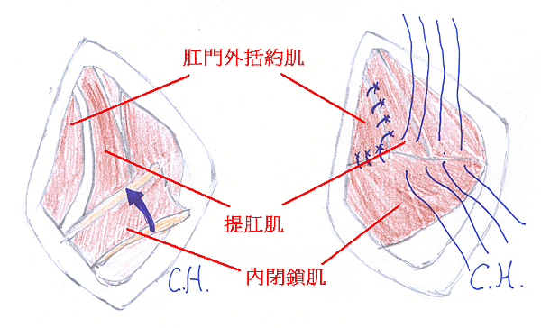 prianal hernia