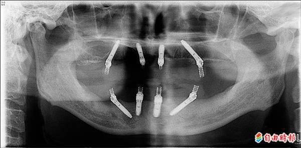 ▲「A11-on-4」快速植牙技術，上、下顎各植入4根植體即可承受一般咬合力。.jpg