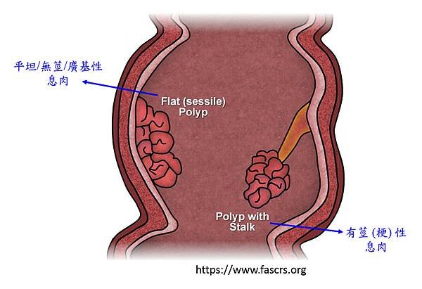 息肉分類-1.tif