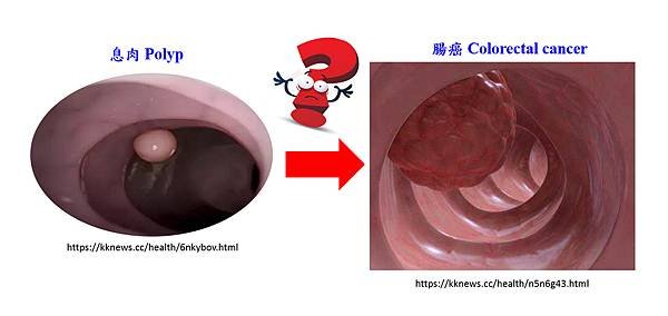 息肉與腸癌.tif