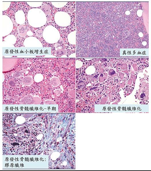 MPN pathology.tif