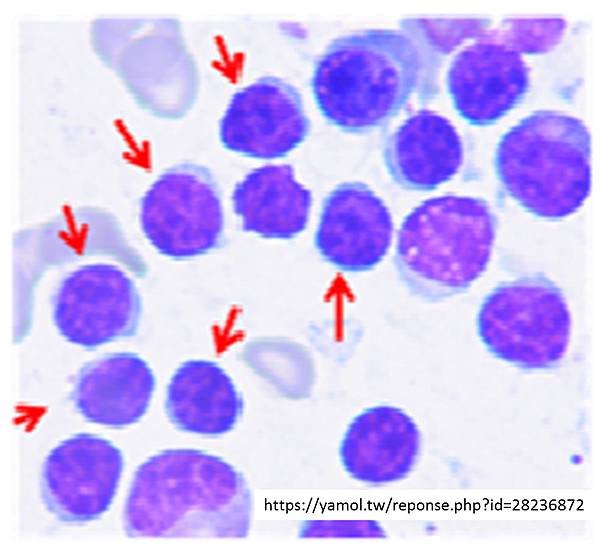 CLL- BLOOD TEST.tif