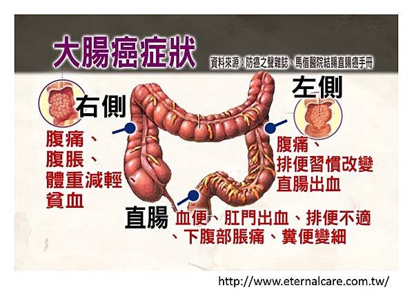 腸癌臨床表現-1.tif