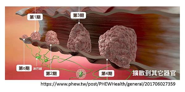 腸癌分期診斷-4.tif