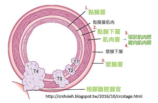 腸癌分期診斷-5.tif