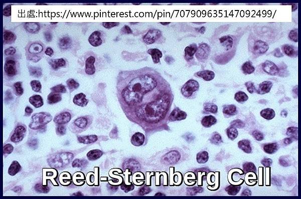 HL-Reed-sternberg cell.tif