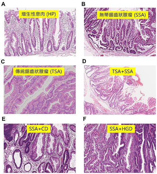 colon polyp BRAF-Histology.tif