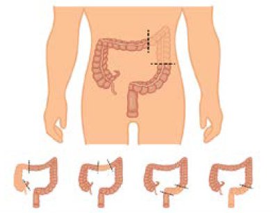 Colon-NCCN-colectomy.tif