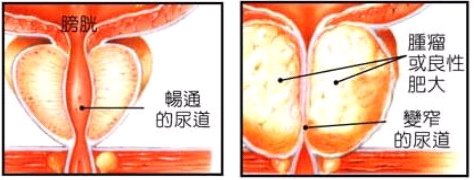 攝護腺肥大