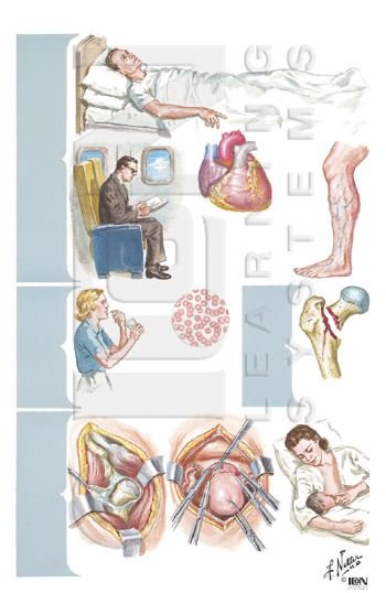 predisposing factors for VTE.jpg