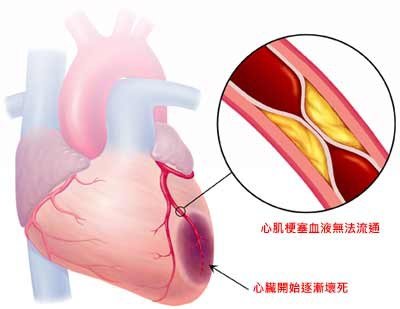 冬天的不定時炸彈~心肌梗塞的急救方法&lt;不管您多忙，務必要看！&gt;