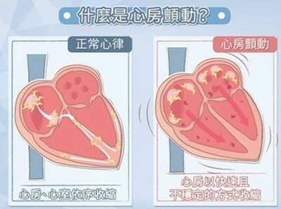 「心房顫動」增加五倍中風機會.jpg