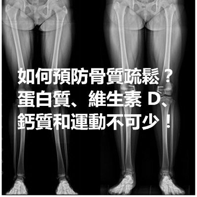 如何預防骨質疏鬆？蛋白質、維生素 D、鈣質和運動不可少！.jpg